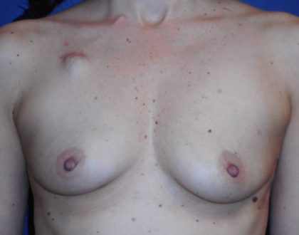 Breast Reconstruction with Direct to Implant with Silicone Implants Before & After Patient #2044