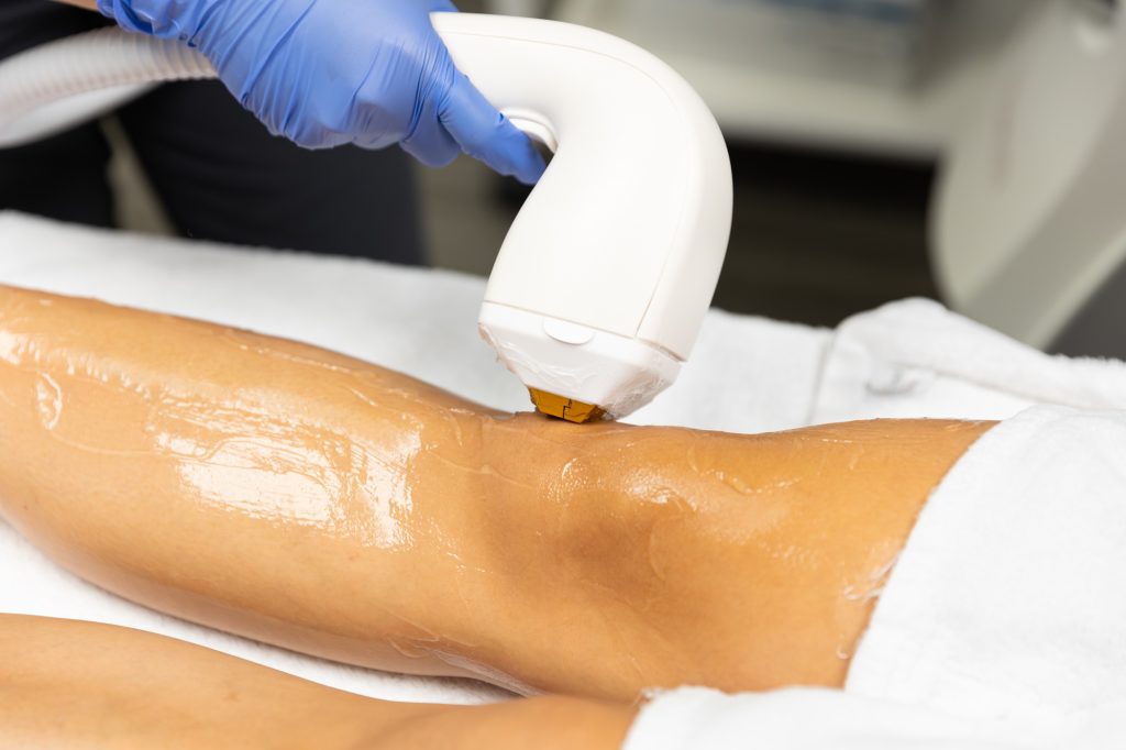 Laser Hair Removal