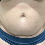 Liposuction Before & After Patient #2102