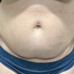 Liposuction Before & After Patient #2102