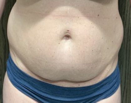 Liposuction Before & After Patient #2102