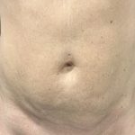 Liposuction Before & After Patient #2102