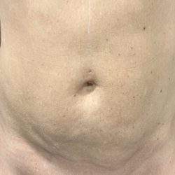 Liposuction Before & After Patient #2102