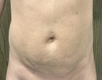 Liposuction Before & After Patient #2102