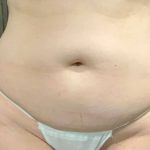 Liposuction Before & After Patient #2101