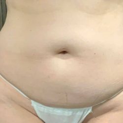 Liposuction Before & After Patient #2101