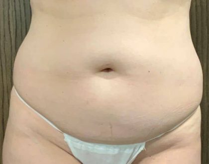 Liposuction Before & After Patient #2101