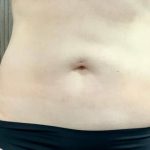 Liposuction Before & After Patient #2101