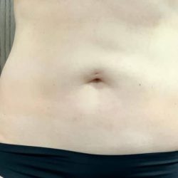 Liposuction Before & After Patient #2101