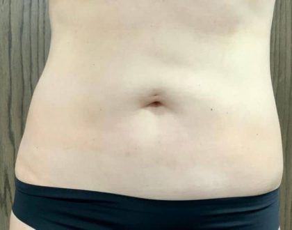 Liposuction Before & After Patient #2101