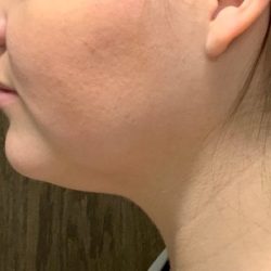 Neck Liposuction Before & After Patient #2105