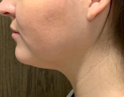 Neck Liposuction Before & After Patient #2105