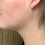 Neck Liposuction Before & After Patient #2105