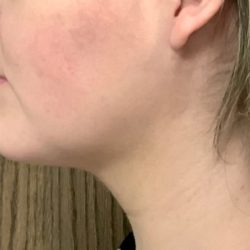 Neck Liposuction Before & After Patient #2105