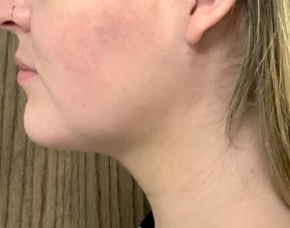 Neck Liposuction Before & After Patient #2105