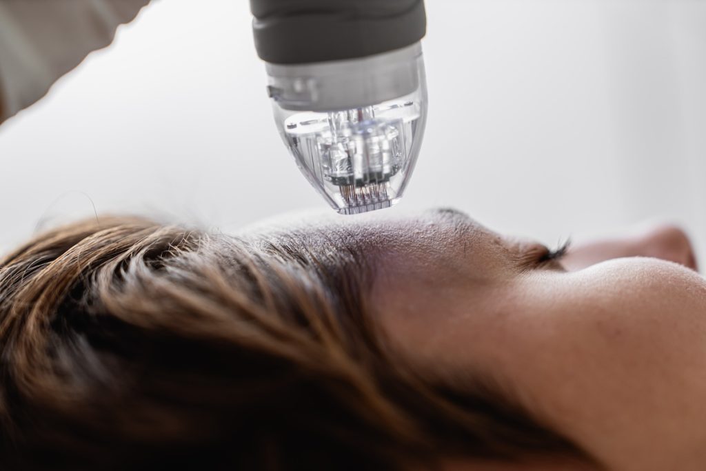 Microchanneling Treatment
