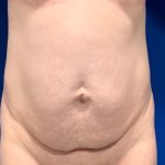 Tummy Tuck Before & After Patient #2110
