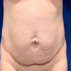 Tummy Tuck Before & After Patient #2110