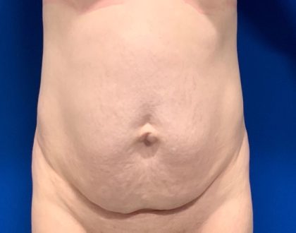 Tummy Tuck Before & After Patient #2110
