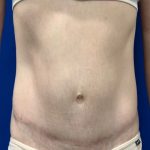 Tummy Tuck Before & After Patient #2110