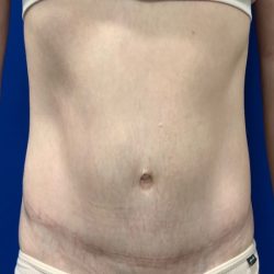 Tummy Tuck Before & After Patient #2110