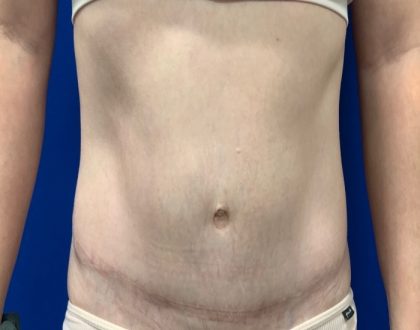 Tummy Tuck Before & After Patient #2110