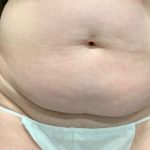 Tummy Tuck Before & After Patient #2109