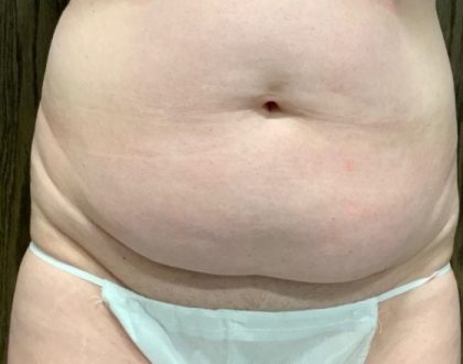 Tummy Tuck Before & After Patient #2109
