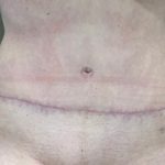 Tummy Tuck Before & After Patient #2109