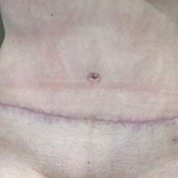 Tummy Tuck Before & After Patient #2109