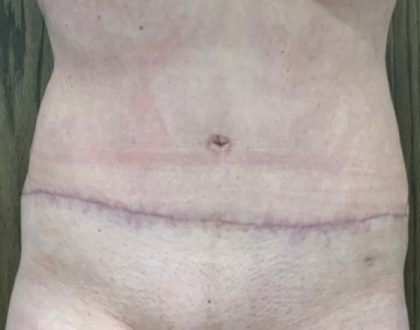 Tummy Tuck Before & After Patient #2109