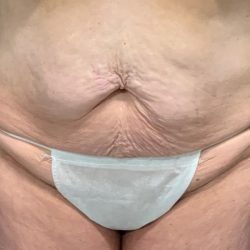 Tummy Tuck Before & After Patient #2108