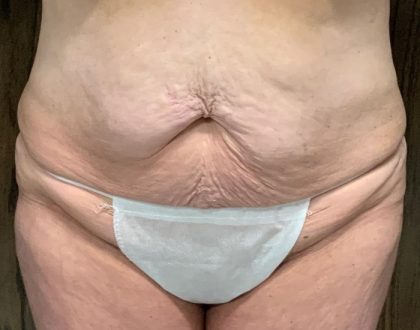 Tummy Tuck Before & After Patient #2108