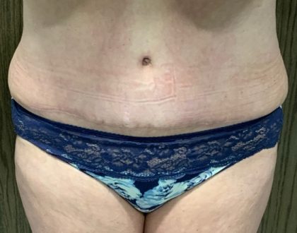 Tummy Tuck Before & After Patient #2108