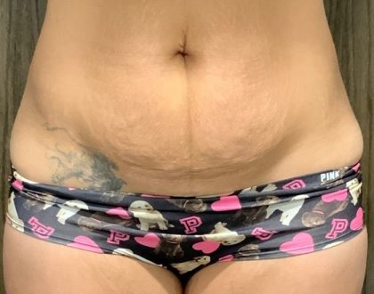 Tummy Tuck Before & After Patient #2107