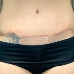 Tummy Tuck Before & After Patient #2107