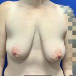Breast Reduction With Galaflex Before & After Patient #2733