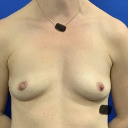 Breast Augmentation Before & After Patient #2633