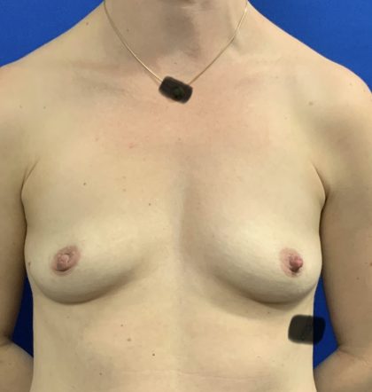 Breast Augmentation Before & After Patient #2633