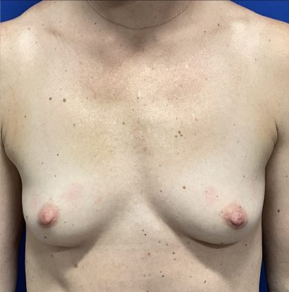 Breast Augmentation Before & After Patient #2632