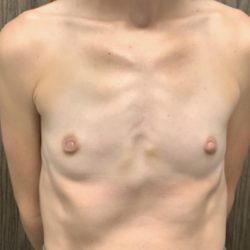 Breast Augmentation Before & After Patient #2666