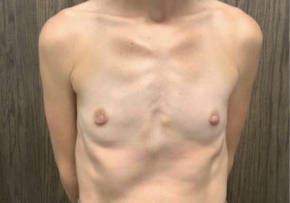 Breast Augmentation Before & After Patient #2666