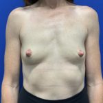 Breast Augmentation Before & After Patient #2667