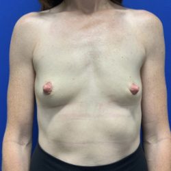 Breast Augmentation Before & After Patient #2667