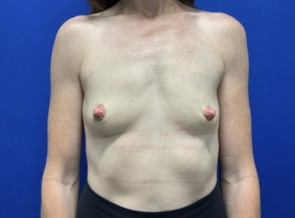Breast Augmentation Before & After Patient #2667