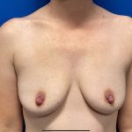 Breast Augmentation Before & After Patient #2635