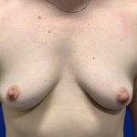 Breast Augmentation Before & After Patient #2671