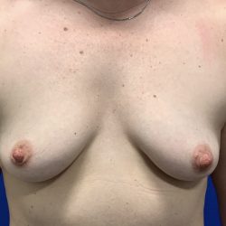 Breast Augmentation Before & After Patient #2671
