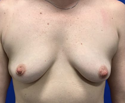 Breast Augmentation Before & After Patient #2671