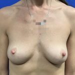 Breast Reconstruction with Direct to Implant with Silicone Implants Before & After Patient #2700